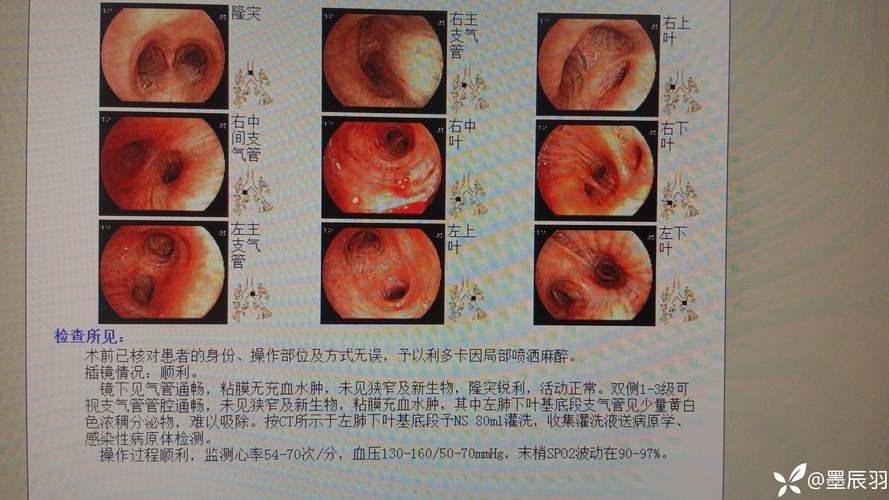 广西壮族自治区桂林市全州县新增3例核酸阳性及15例无症状(桂林全州新冠肺炎感染人员名单)