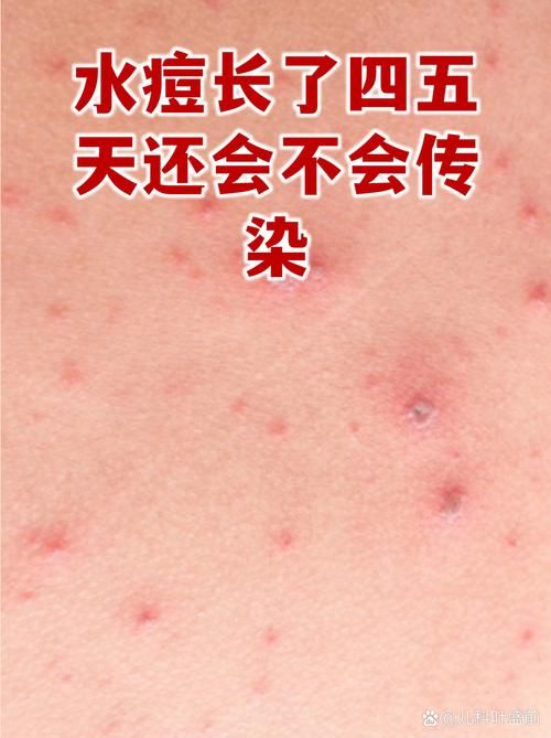 浙江温州永嘉县4月20日无新增重症/温州永嘉新型冠状病毒