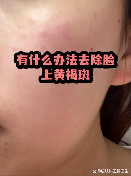 疫情最新报告北林区新闻_脸上长黄褐斑看什么科