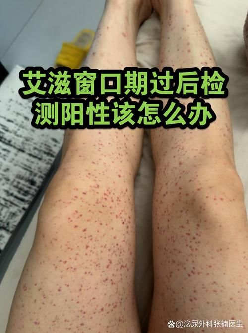 全球增21例阳性感染者/全球26例抗体阴性艾滋病